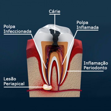 Tratamento de Canal (Endodontia)